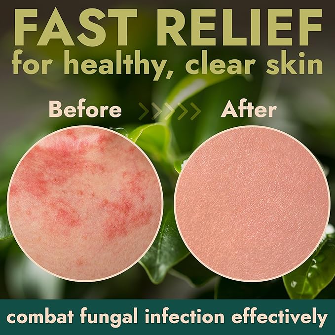 Body Spray with Tea Tree Oil | Fast-Absorbing Antifungal Treatment for Jock Itch, Athlete’s Foot, Ringworm & Nail Fungus | Soothes Itching, Burning & Scaling | Relieves Irritated Skin | 120ml